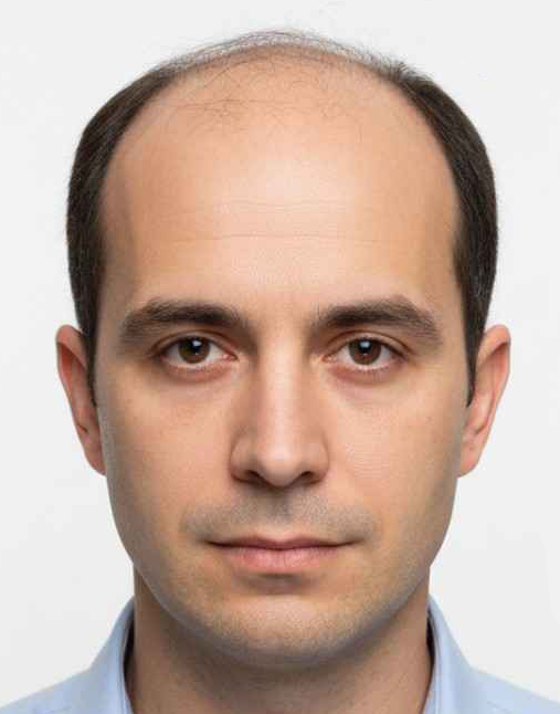 Before — Hairline restoration · 2,800 grafts
